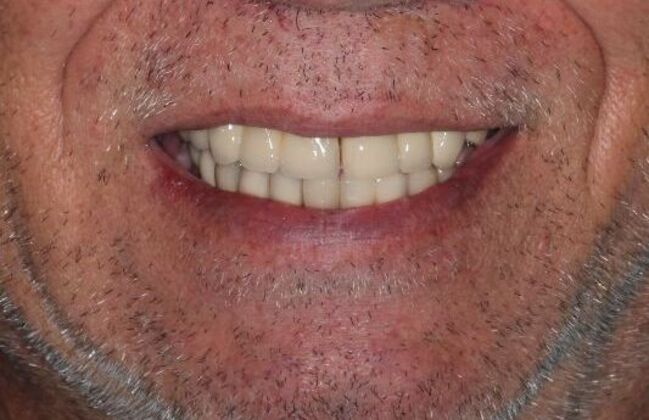 Dentures: Case 14 - Before