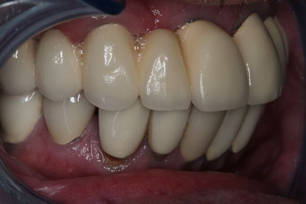 Dentures: Case 14 - Before