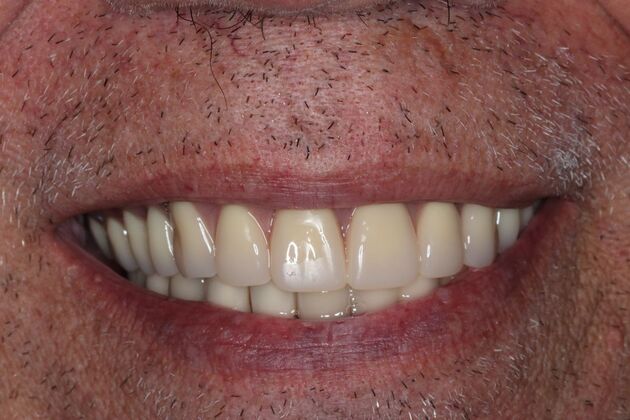 Dentures: Case 14 - Upper Denture