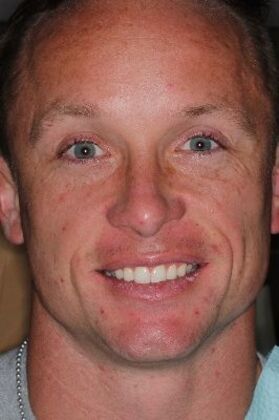 Invisalign Case 1 - Before