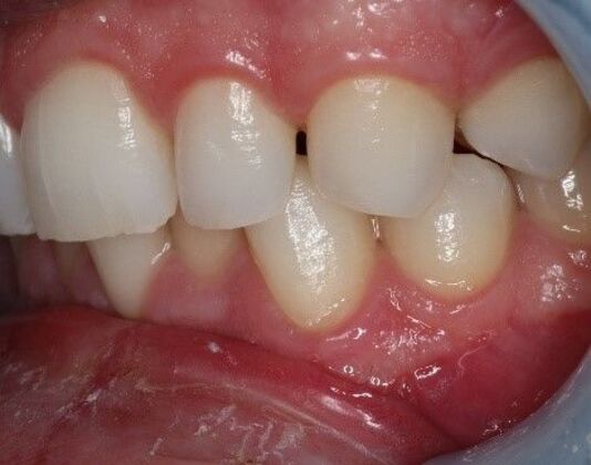 Invisalign: Case 1 - Before