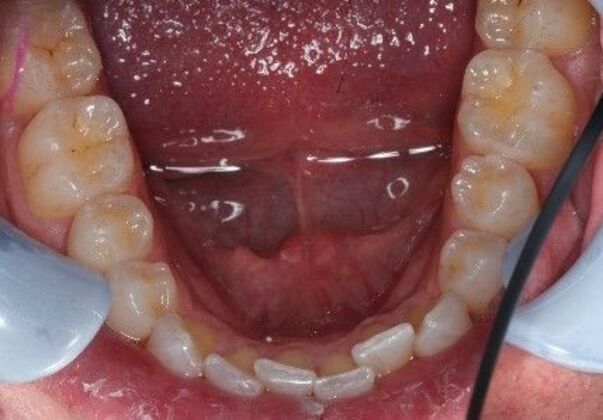 Invisalign: Case 1 - Before