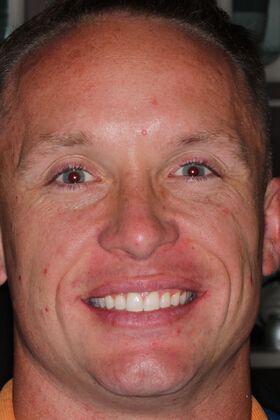 Invisalign Case 1 - After