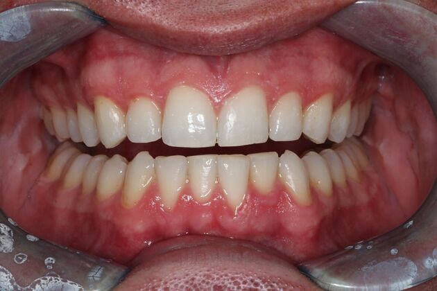 Invisalign: Case 1 - After