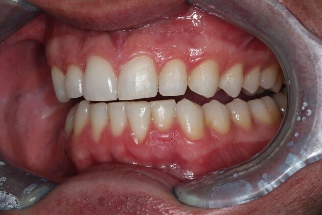 Invisalign: Case 1 - After