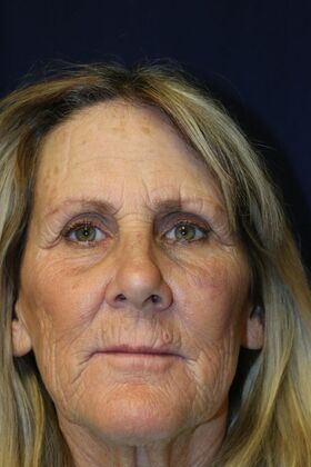CO2 Laser Resurfacing: Case 3 - Before