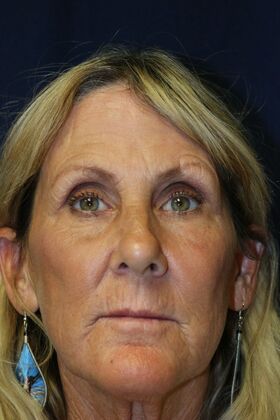 CO2 Laser Resurfacing: Case 3 - After