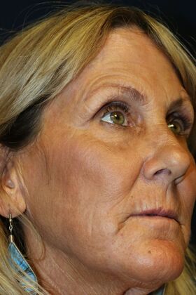 CO2 Laser Resurfacing: Case 3 - After