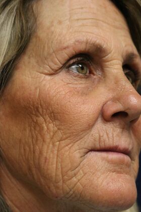 CO2 Laser Resurfacing: Case 3 - Before