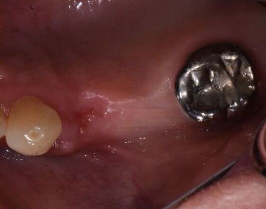 Dental Implants Case 20 - Seadrift, TX - Before