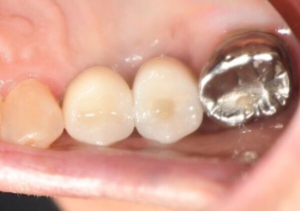 Dental Implants Case 20 - Seadrift, TX - After