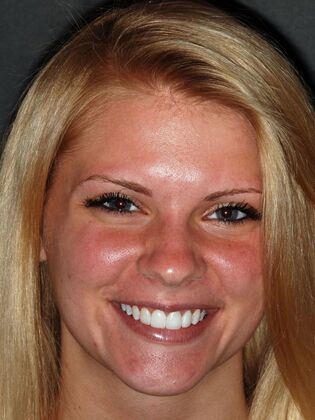 Porcelain Crowns Amber C. - After
