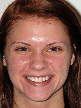 Veneers: Amber C. - Before