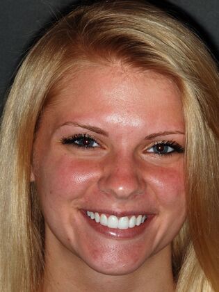 Veneers: Amber C. - After