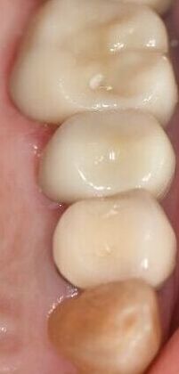 Crowns Case 25 - Victoria, TX - After