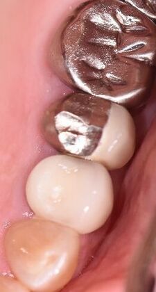 Crowns Case 25 - Victoria, TX - Before