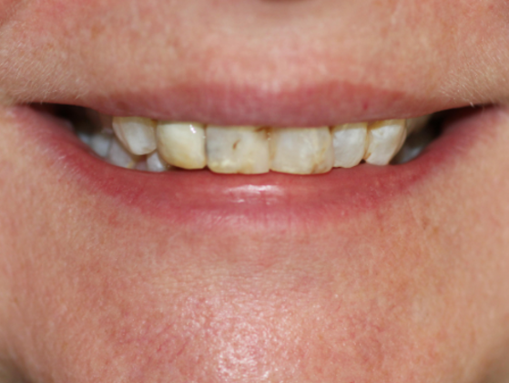 Smile Makeovers, actual cases of our dentists, no special lighting or editing Case 24 - Before