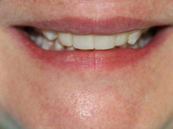 Smile Makeovers, actual cases of our dentists, no special lighting or editing Case 24 - After