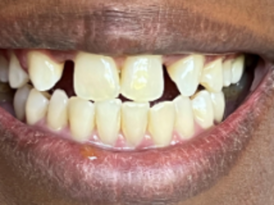 Smile Makeovers, actual cases of our dentists, no special lighting or editing Case 25 - Before