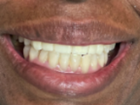 Smile Makeovers, actual cases of our dentists, no special lighting or editing Case 25 - After