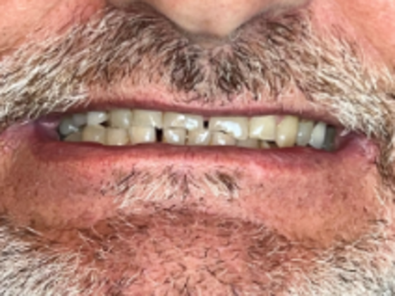 Smile Makeovers, actual cases of our dentists, no special lighting or editing Case 26 - Before