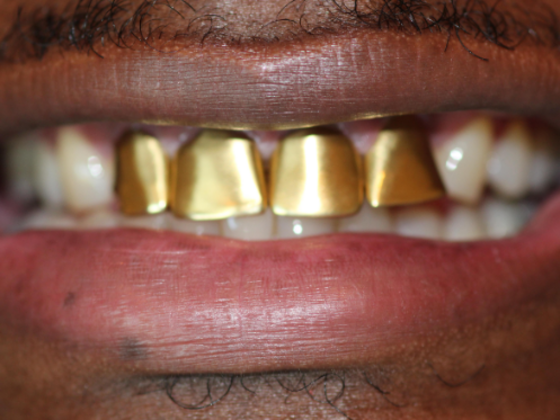 Smile Makeovers, actual cases of our dentists, no special lighting or editing Case 27 - Before