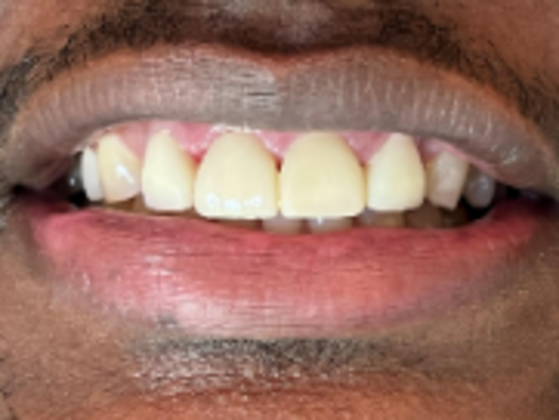 Smile Makeovers, actual cases of our dentists, no special lighting or editing Case 27 - After