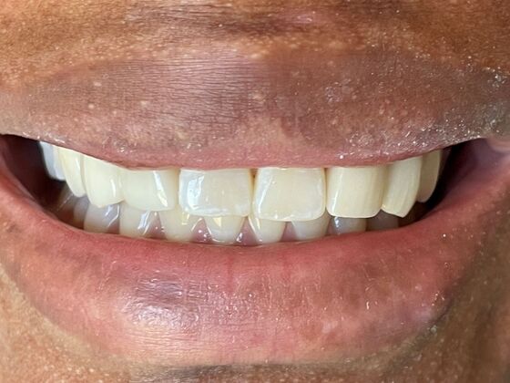 Smile Makeovers, actual cases of our dentists, no special lighting or editing Case 28 - After