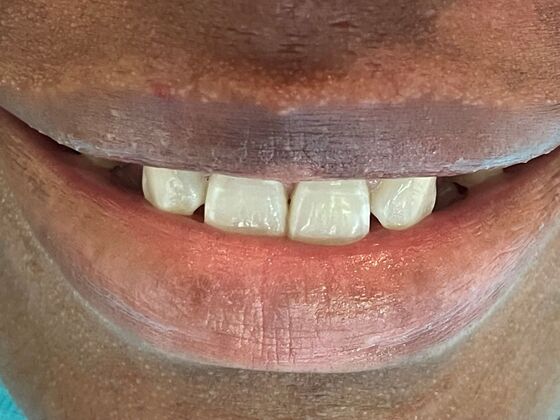 Smile Makeovers, actual cases of our dentists, no special lighting or editing Case 28 - Before
