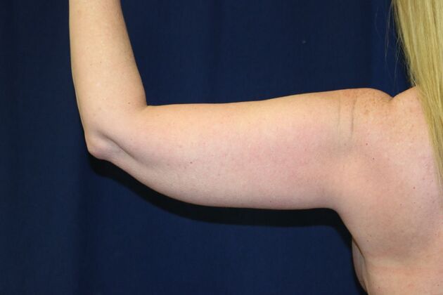 Arm Lift*/Arm Sculpting: Case 15 - Before