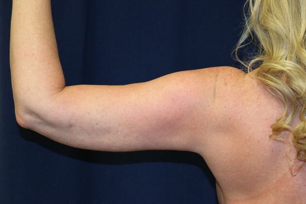 Arm Lift*/Arm Sculpting: Case 15 - Before