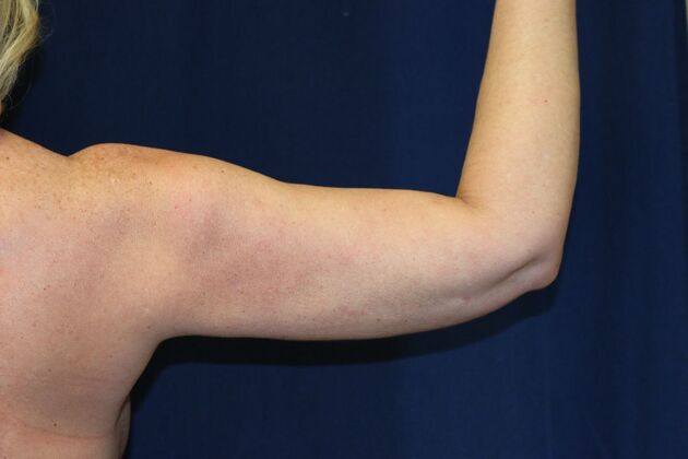 Arm Lift*/Arm Sculpting: Case 15 - After