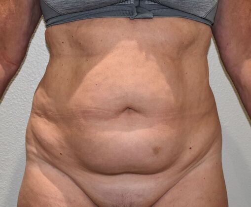 Tummy Tuck (Abdominoplasty): Case 350 - Before