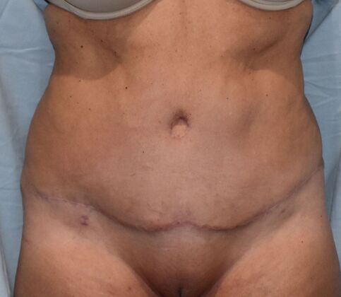 Tummy Tuck (Abdominoplasty): Case 350 - After