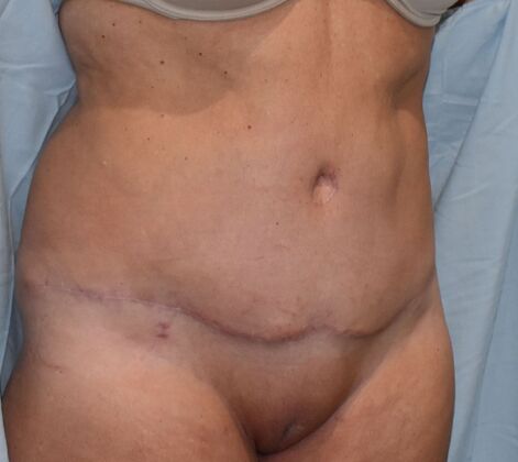 Tummy Tuck (Abdominoplasty): Case 350 - After