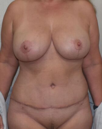 Mommy Makeover Case 231 - After