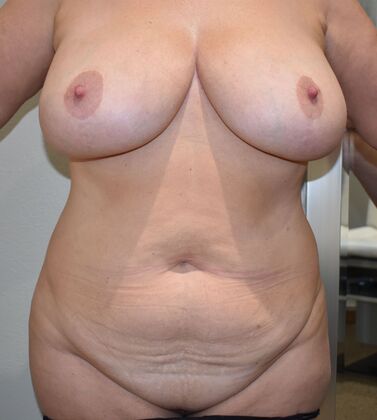 Mommy Makeover Case 231 - Before