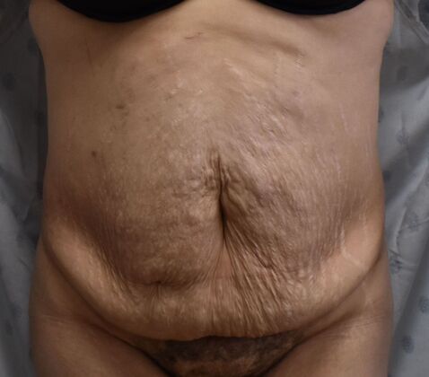 Tummy Tuck (Abdominoplasty): Case 352 - Before