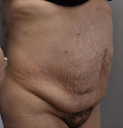 Tummy Tuck (Abdominoplasty): Case 352 - Before