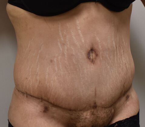 Tummy Tuck (Abdominoplasty): Case 352 - After