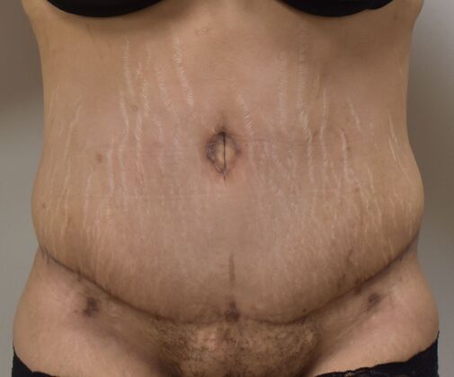 Tummy Tuck (Abdominoplasty): Case 352 - After