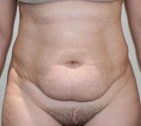 Tummy Tuck (Abdominoplasty): Case 354 - Before