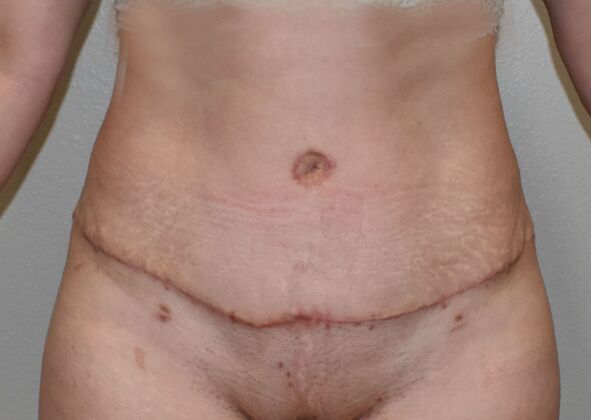 Tummy Tuck (Abdominoplasty): Case 354 - After