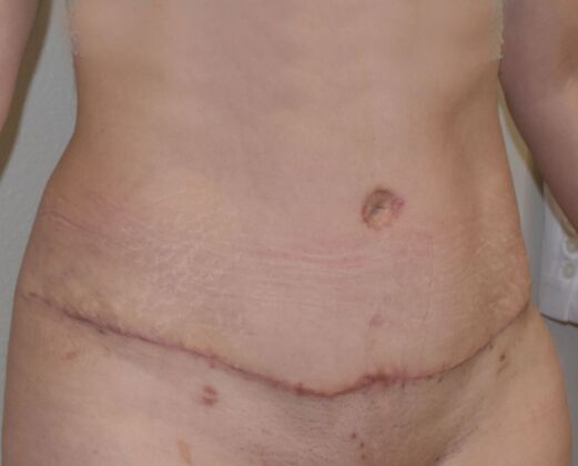 Tummy Tuck (Abdominoplasty): Case 354 - After