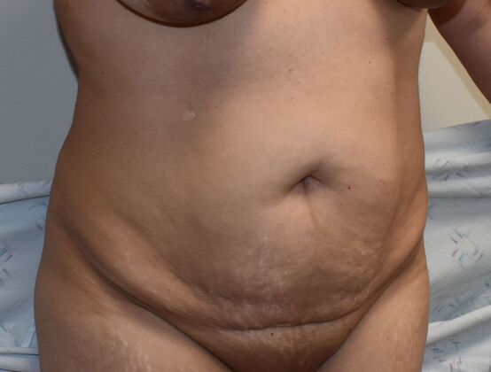 Tummy Tuck (Abdominoplasty): Case 355 - Before