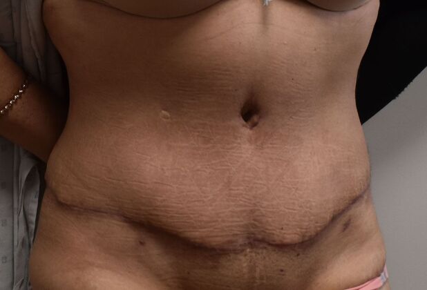 Tummy Tuck (Abdominoplasty): Case 355 - After