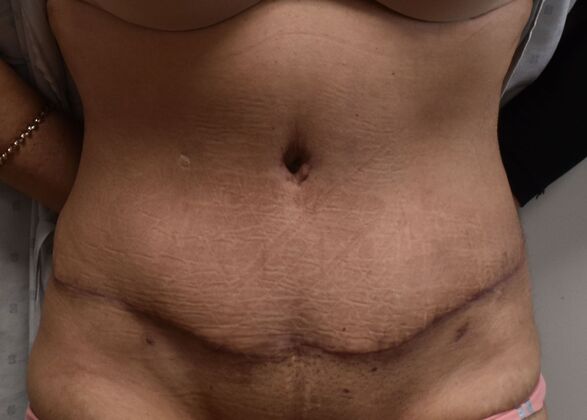 Tummy Tuck (Abdominoplasty): Case 355 - After