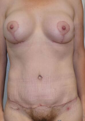 Massive Weight Loss : Case 103 - After