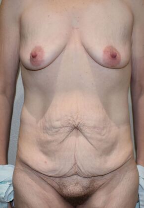 Mommy Makeover Case 233 - Before