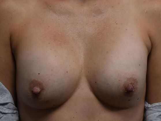 Breast Revision: Case 193 - Before